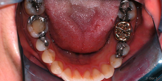 Metalle im Mund: Goldkrone neben Amalgamfüllungen