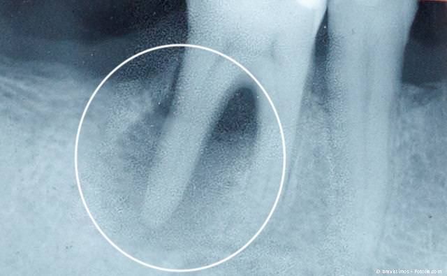 Entzündung an der Wurzelspitze eines Zahnes: Soll er gezogen oder erhalten werden?