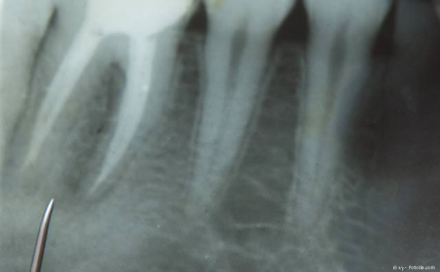 Bakterien in wurzelbehandelten Zähnen können Gifte produzieren.